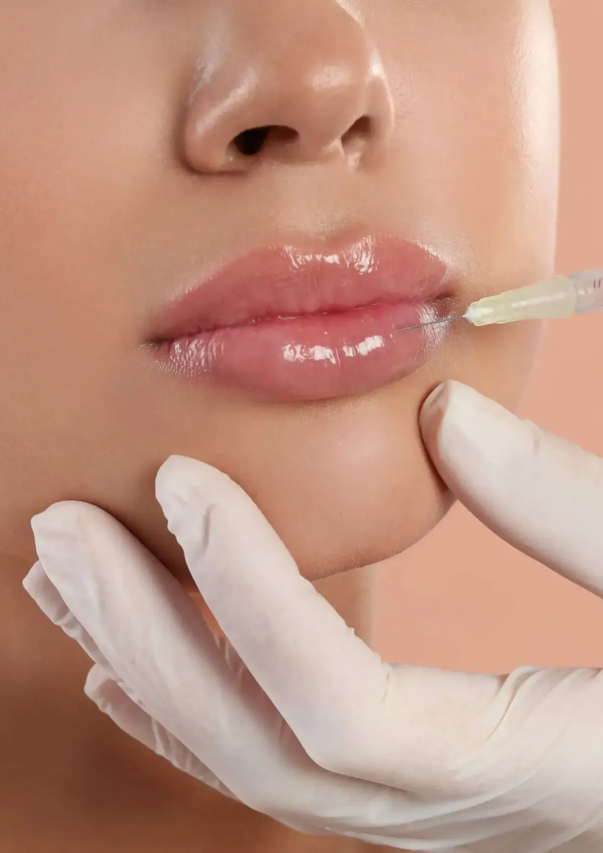 Aplicação de Preenchimento - Harmonização Facial em Joinville Aplicação de preenchimento nos lábios como parte da harmonização facial na Clínica Dra. Simoni Bett, Joinville