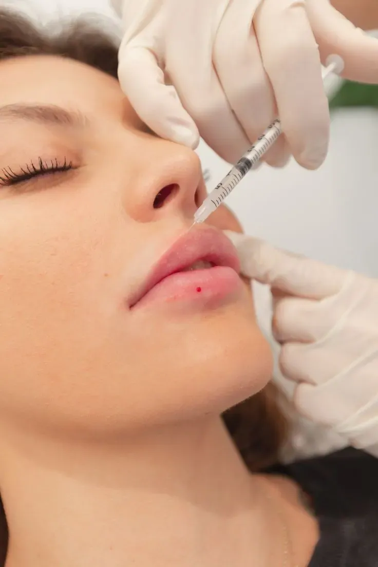 Atendimento de Harmonização Facial em Joinville Aplicação injetável próxima à região dos lábios em atendimento de harmonização facial na Clínica Dra. Simoni Bett, Joinville