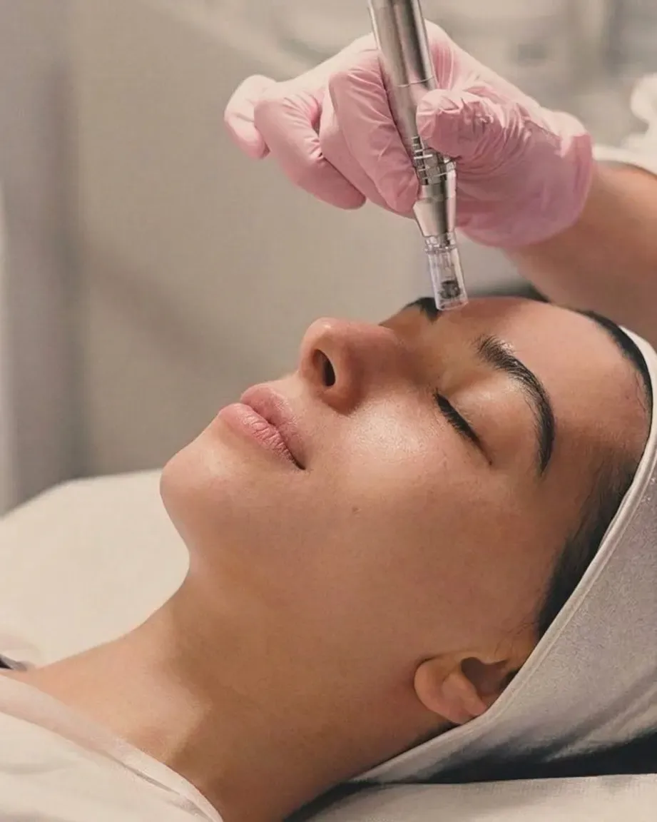 Microagulhamento com Dermapen em Joinville Microagulhamento com dermapen aplicado no rosto de paciente deitada na Clínica Dra. Simoni Bett, Joinville