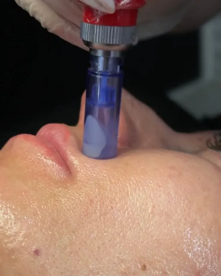 Ponteira de Dermapen - Microagulhamento em Joinville Close de ponteira de dermapen sobre a pele do rosto em microagulhamento na Clínica Dra. Simoni Bett, Joinville
