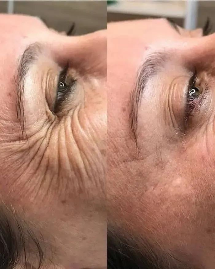 Resultado - Bioestimuladores de Colágeno em Joinville Resultado de tratamento de firmeza facial na Clínica Dra. Simoni Bett, Joinville